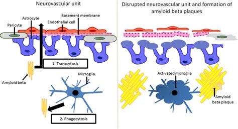 amyloid beta plaque|Amyloid.
